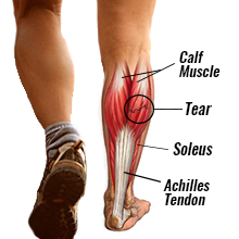 The image shows the tear on the muscles of a leg. 